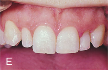 <ul><li><p>abnormally small teeth</p></li><li><p>result of abnormal proliferation during bud stage</p></li><li><p>most commonly affects maxillary lateral incisors and third molars</p></li></ul><p></p>
