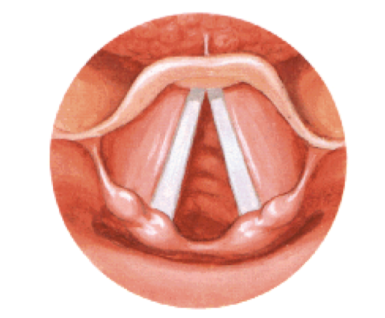 <p>Espacio comprendido entre cuerdas vocales inferiores</p><ul><li><p>Abierto - real</p></li></ul><p>Abre o cierra depende de constricción o dilatación de cuerdas vocales</p>