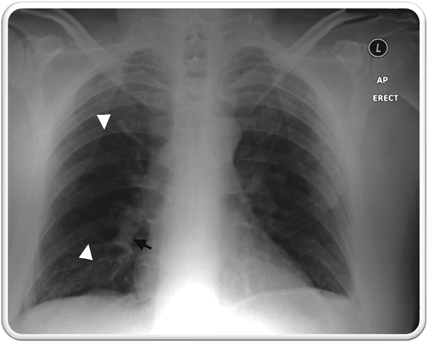 <p>rare; sharp cut off of pulmonary vessels w/ distal hypo perfusion in a segmental distribution w/in the lung</p><p>pathognomic for PE</p>