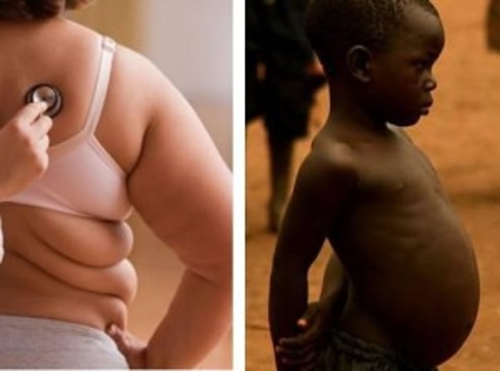 <p>"bad nutrition" - a diet which is unbalanced (may be too much or not enough of nutrients).</p>