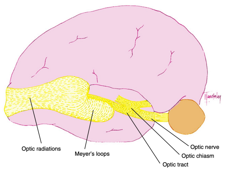 <p>Inferior retinal fibers leave the LGN from the lateral aspect, pass into the temporal lobe and loop around the tip of the temporal horn of the lateral ventricle. This is caller Meyer’s Loop. • Superior retinal fibers leave the LGN from the medial aspect and lie superiorly as they pass through the parietal lobe. • Macular fibers are situated between superior and inferior fibers.</p>