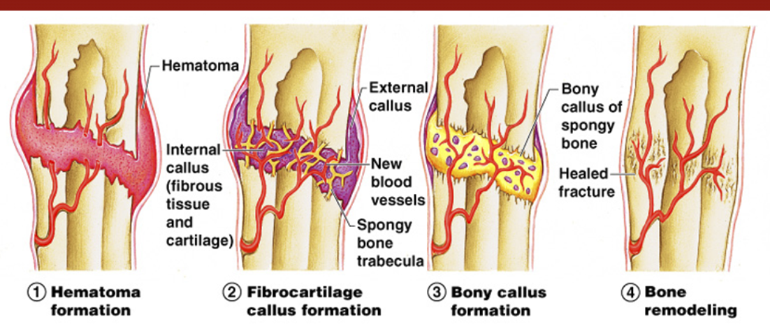 <ul><li><p><span style="font-family: &quot;Trebuchet MS&quot;, sans-serif">Takes 6-8 weeks</span></p></li></ul><ol><li><p><span style="font-family: &quot;Trebuchet MS&quot;, sans-serif">Hematoma forms</span></p></li><li><p><span style="font-family: &quot;Trebuchet MS&quot;, sans-serif">Fibrocartilage callus forms</span></p></li><li><p><span style="font-family: &quot;Trebuchet MS&quot;, sans-serif">Bony callus forms</span></p></li><li><p><span style="font-family: &quot;Trebuchet MS&quot;, sans-serif">Bone remodeling occurs</span></p></li></ol><ul><li><p><span style="font-family: &quot;Trebuchet MS&quot;, sans-serif">External callus forms here (scar tissue)</span></p></li></ul><p></p>