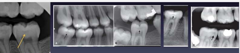 <p>thin line, triangle, or cup-shaped zone under enamel w base at DEJ </p>