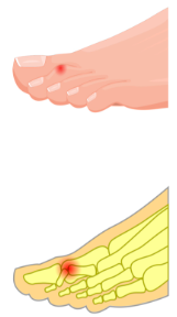 PIP fixed in flexion 