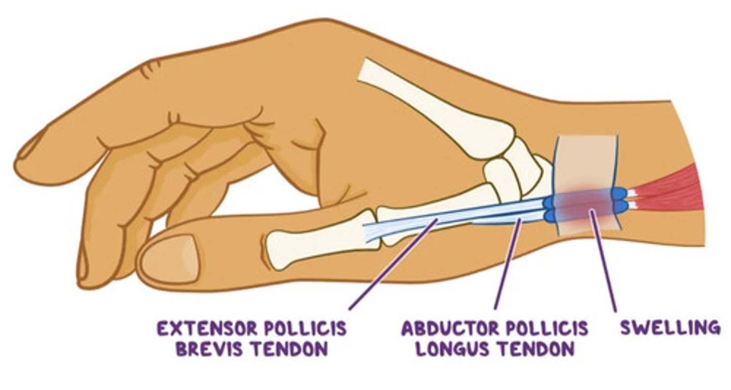 <p>inflammation of the tendon and synovial membrane</p>