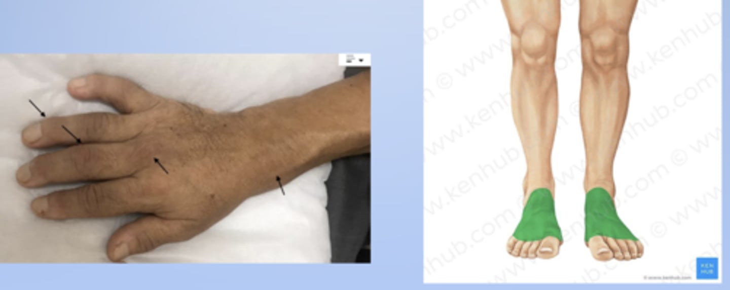 <p>anterior or top of the foot or the back of the hand</p>