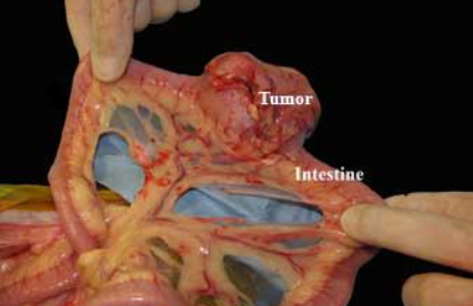 <ol><li><p><strong>lymphoma</strong></p></li><li><p>adenocarcinoma</p></li><li><p>leiomyosarcoma</p></li><li><p>gastrointestinal stromal tumors (GIST)</p></li><li><p>carcinoids</p></li></ol><p></p>