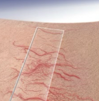 <p>what type of lesion is depicted</p>