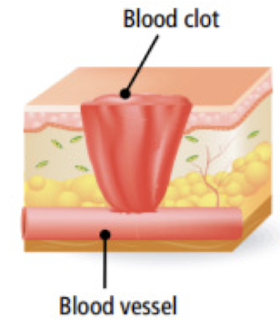 <p>Which <strong>first</strong> <strong>phase</strong> of wound healing occurs <strong>within minutes post-injury </strong>when platelets aggregate at injury site to form fibrin?</p>