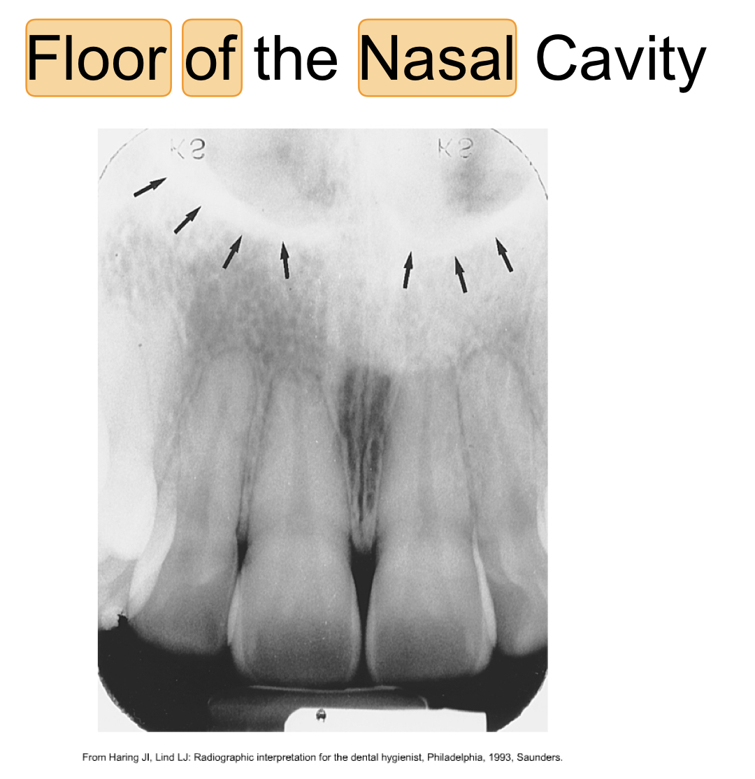 * bony wall formed by palatal processes
* radiopaque