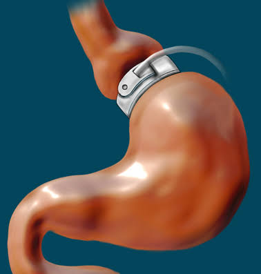 <p>who controls the band tightness in gastric banding?</p>