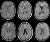 <p>enlargement with age, more significant with dementia</p>