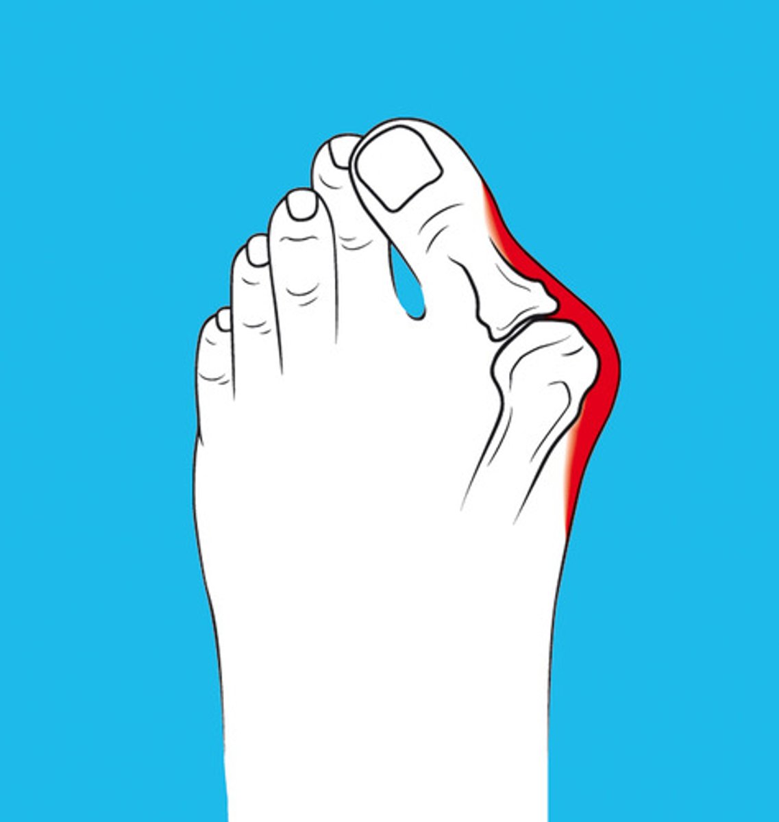 <p>Great toe deviates laterally; may overlap second toe; bunion may form.</p>