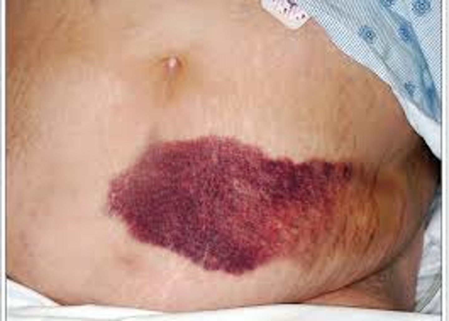 <p>greater than 10 mm, bruise</p>