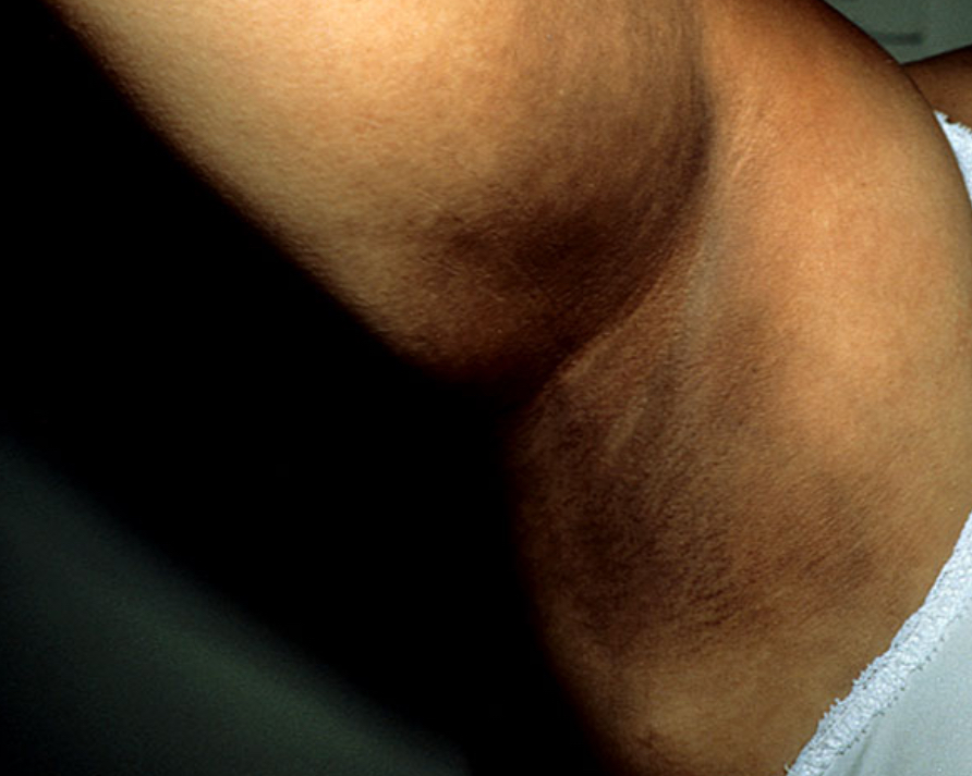 <ul><li><p>Acanthosis nigricans (hyperpigmentation of skin folds due to high ACTH → too much alpha melanocyte stimulating hormone)</p></li></ul><ul><li><p>Tanned appearance </p></li></ul><p></p>