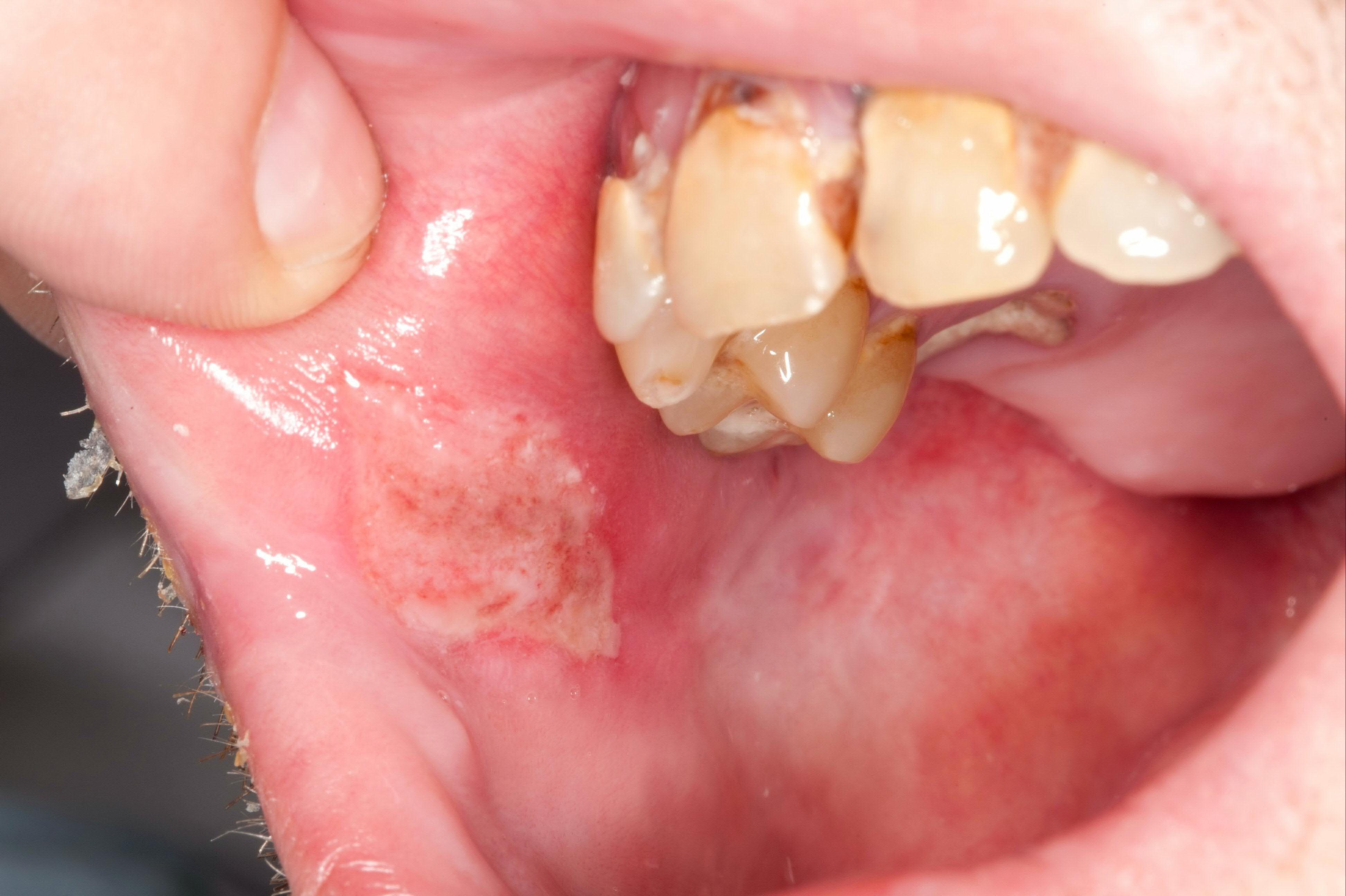 <p>35 yo woman w/ multiple painful oral ulcers (pic), hx anterior uveitis, genital lesions, scattered hyperpigmented lesions, and tender, indurated areas on legs. </p><p>dx?</p>