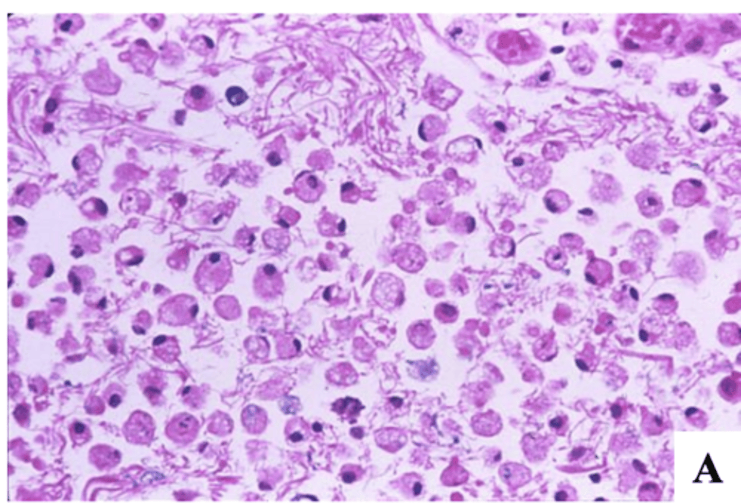 <p>4-7 days after the stroke:</p><p>-neuronal dropout</p><p>-influx of macrophages (microglial cells -> clean up necrotic debris), fewer lymphocytes and polys</p><p>-vascular proliferation</p>
