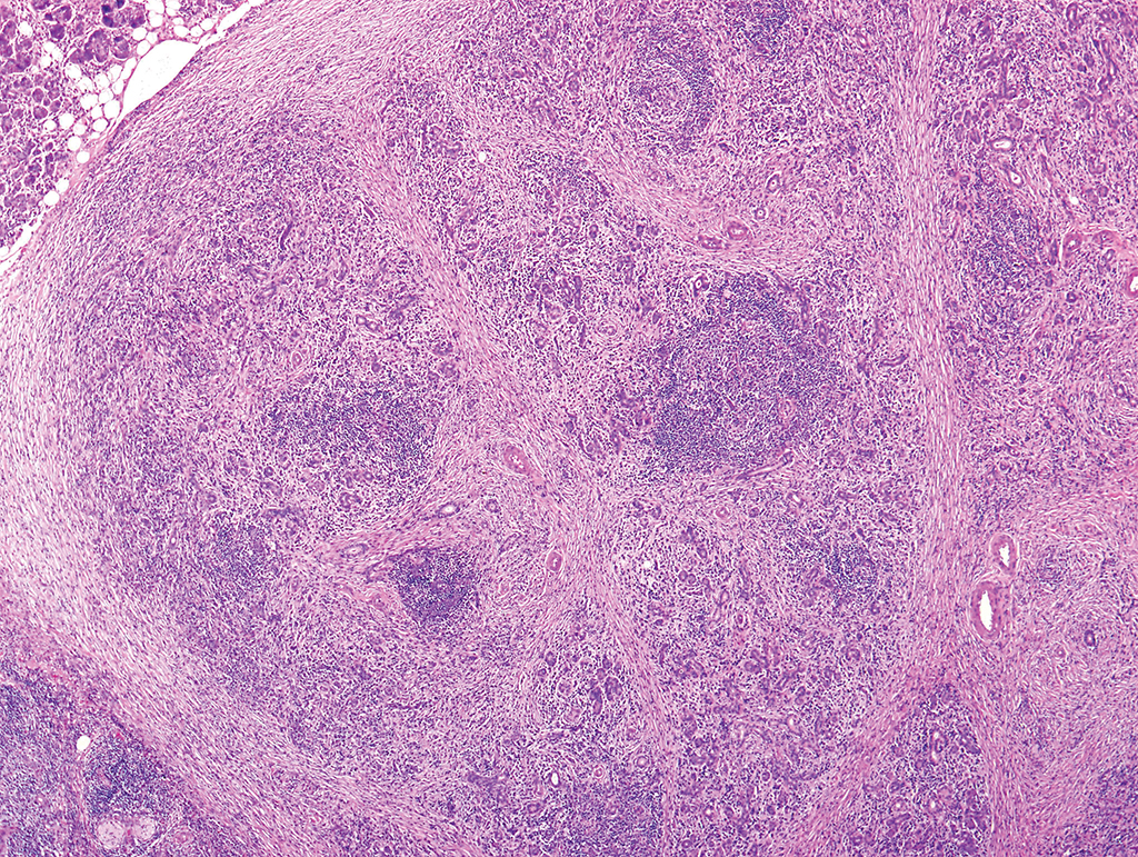 <p>Patient de 45 ans, glande salivaire taux sériques IgG4 augmentés </p><p>1) diagnostic </p><p>2) Triade diagnostique </p>