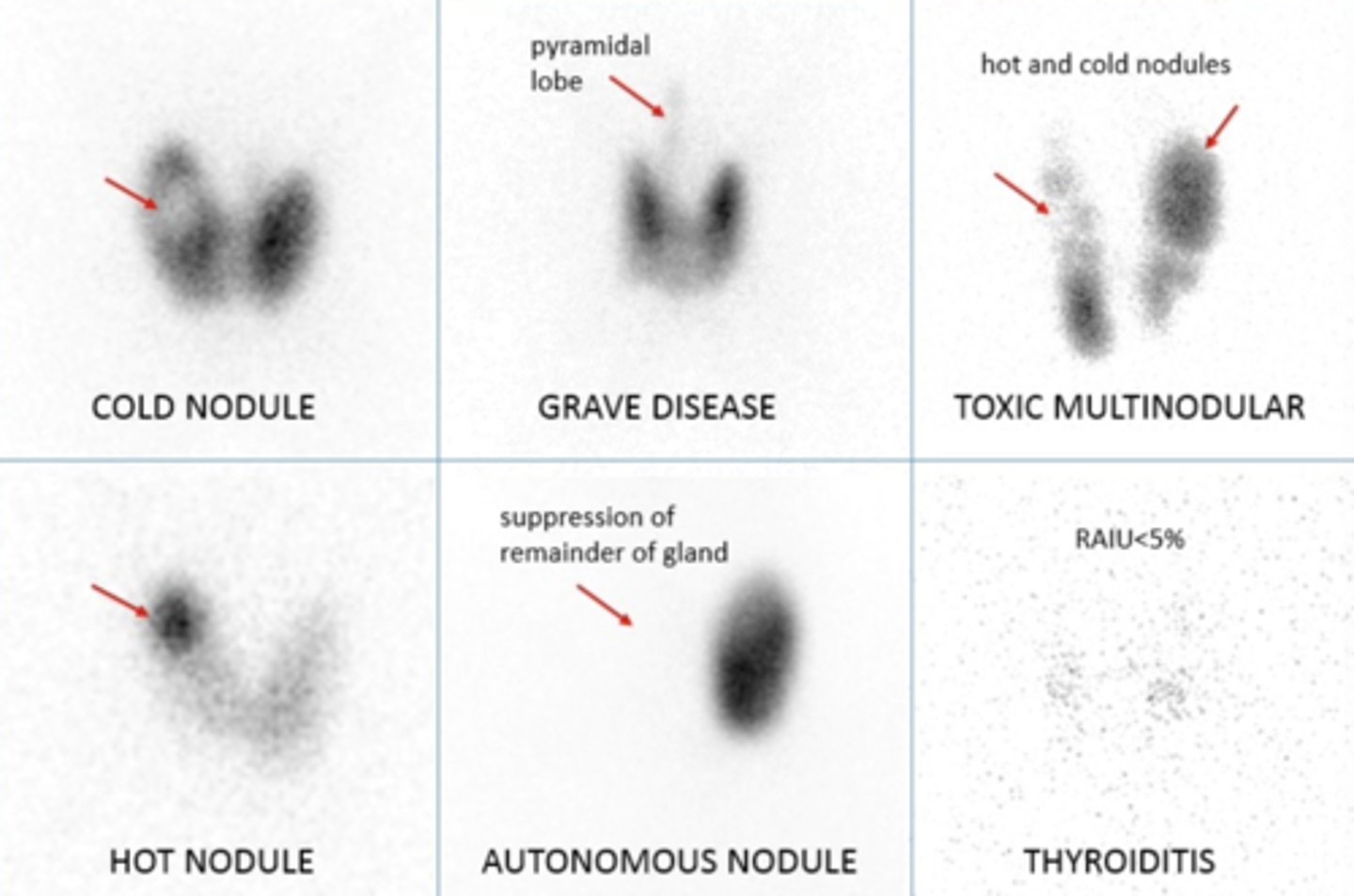 <p>darker indicates more thyroid hormone</p>