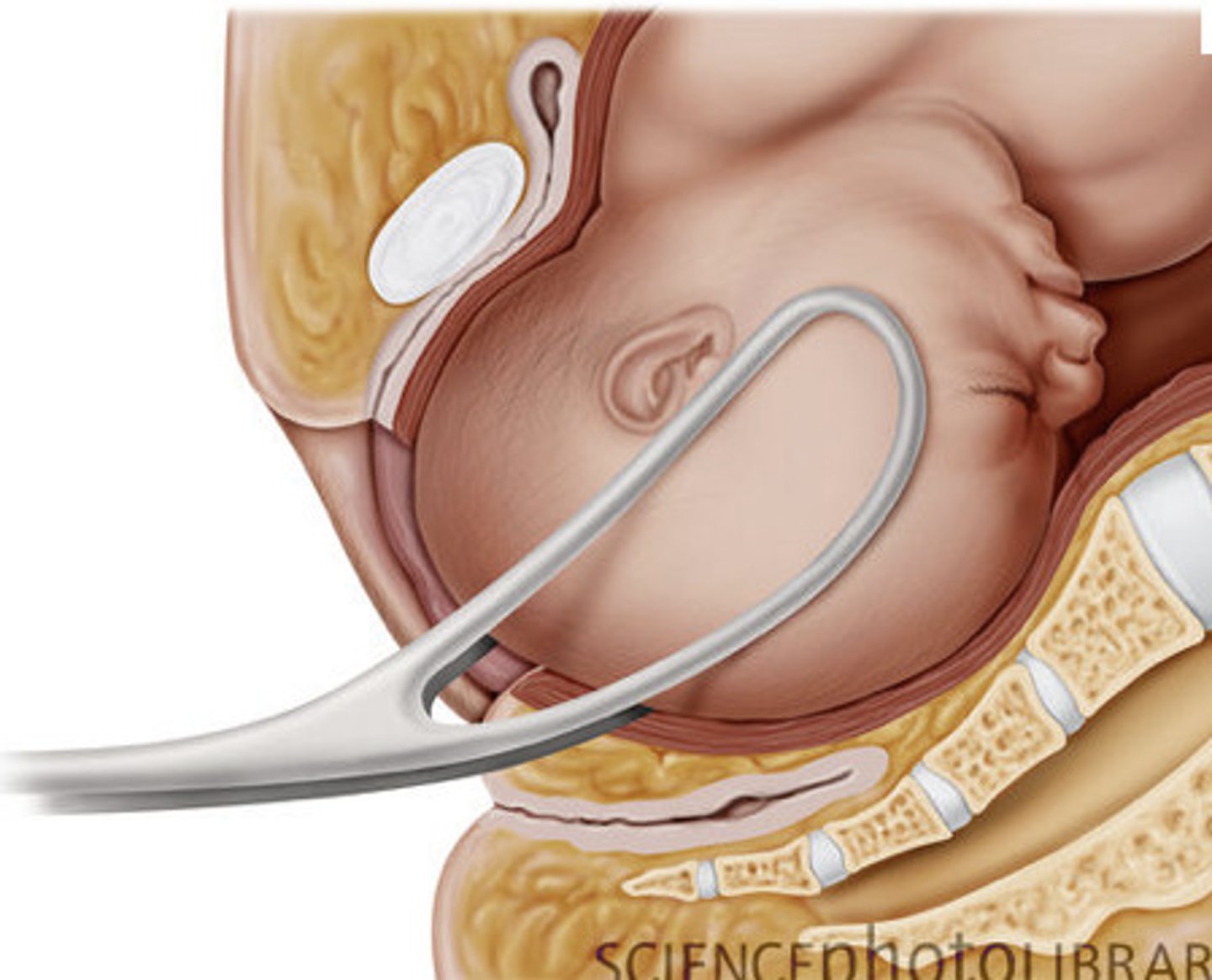 <p>are applied to either side of the fetal head to allow the provider to pull with contractions.</p><p>Cesarean deliveries are performed if it is difficult to apply forceps safely or delivery does not occur within 15 to 20 minutes.</p>