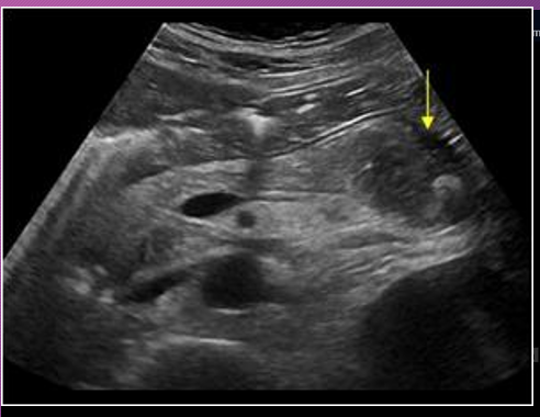 <p>______ seen within the pseudocyst may occur from complications of ______ or _______</p>