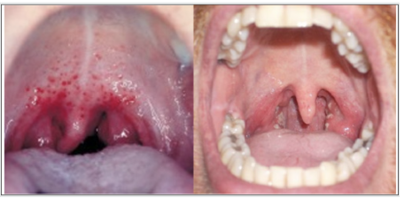 <p>-Neisseria gonorrhea infection transmitted via oral sex &amp; occurs simultaneously with genital gonorrhea</p><p>-Asymptomatic or with sx: Sore throat, pharyngeal exudates, lymphadenopathy</p><p>-DX: Culture or NAAT</p><p>-TX: Single dose of Ceftriaxone 1g IM</p>
