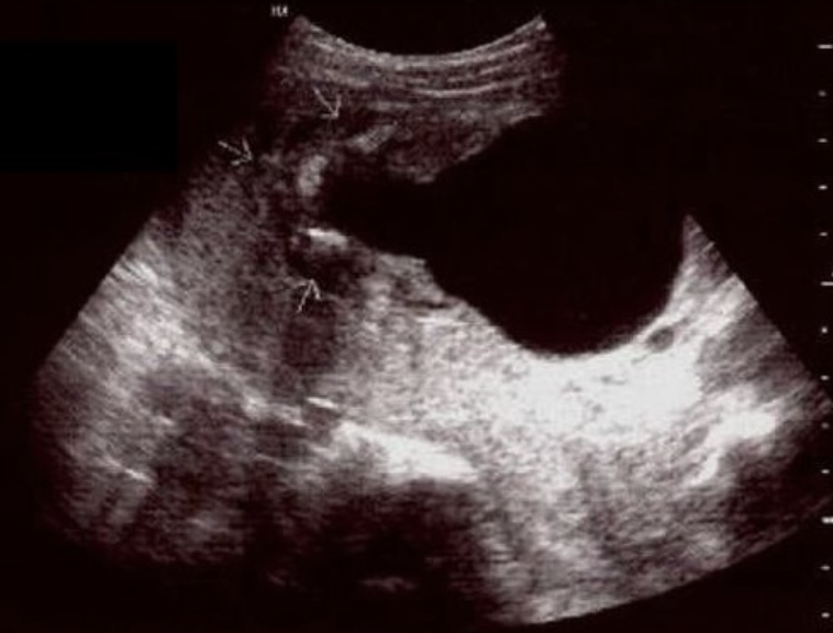 <p>a) most likely a female fetus</p><p>b) fetus probably has potter syndrome</p><p>c) fetus probably has turner syndrome</p><p>d) most likely a male fetus</p>