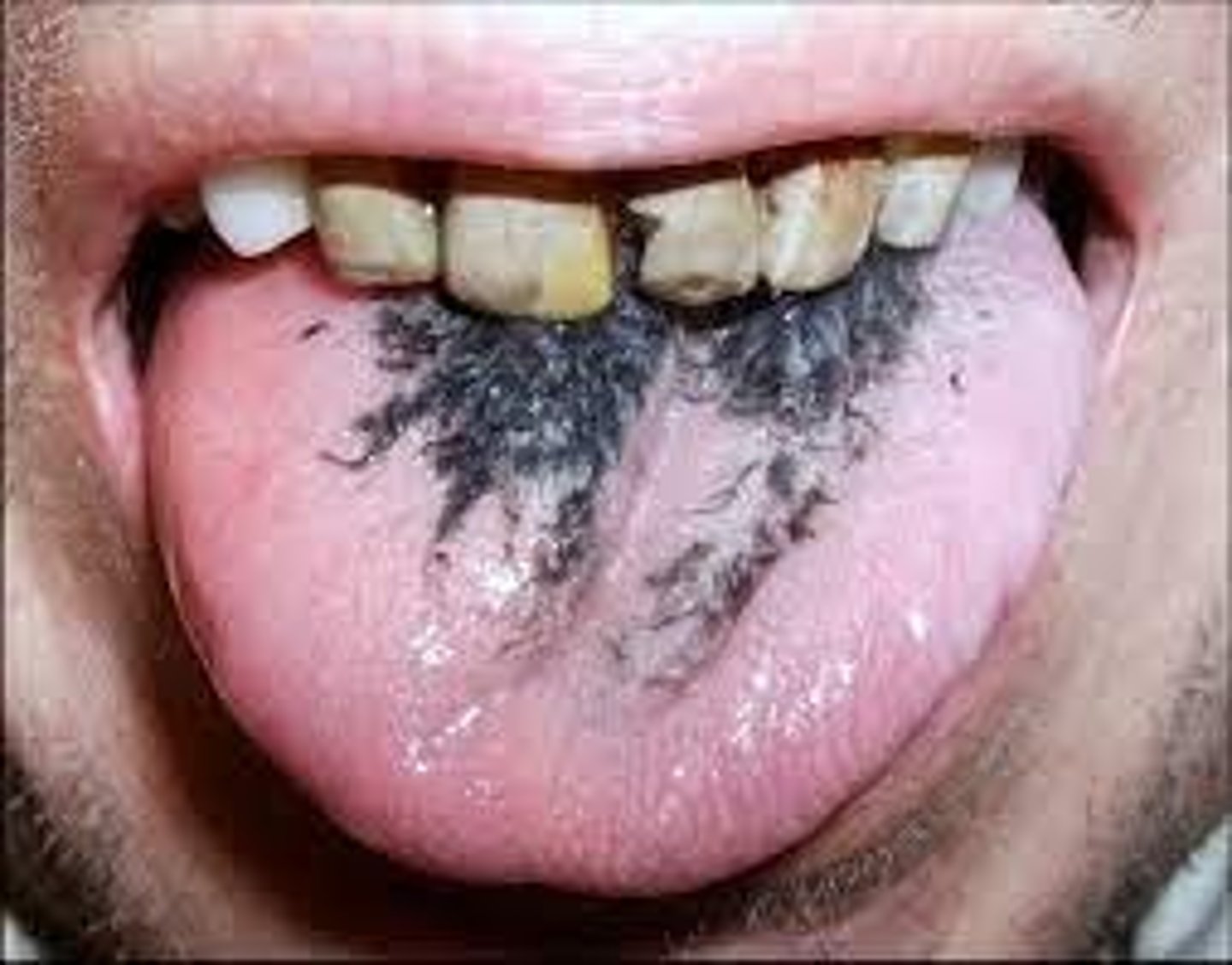<p>A recurrent inflammatory disorder affecting the dorsum of the tongue, characterized by local loss of filiform papillae leading to red patches with white, polycyclic borders.</p>