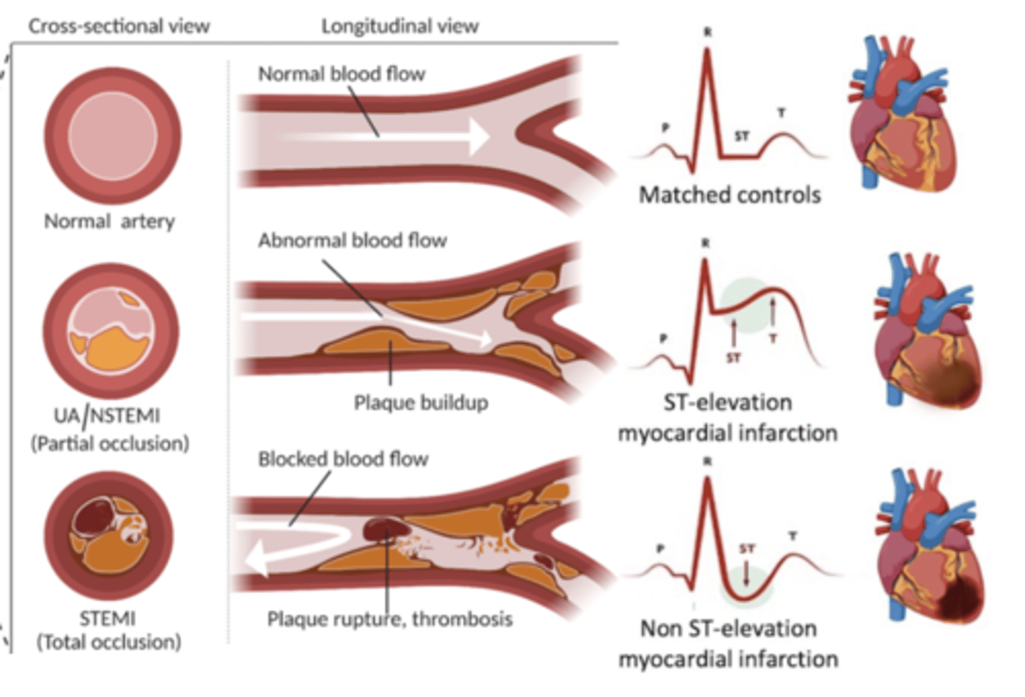 <p>STEMI (ST elevation MI):</p><p>- ST elevation on ECG</p><p>- total occlusion/blockage of coronary artery</p><p>NSTEMI (non ST elevation MI):</p><p>- no ST elevation on ECG</p><p>- partial occlusion/blockage of coronary artey</p><p>- troponin (cTn) elevated</p>