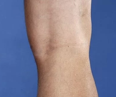 <p>Comment nomme-t-on l’arrière du genou, cette zone creuse située entre la cuisse et le mollet ?</p>