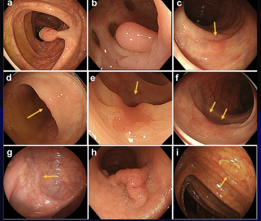 <p>a flexible fiberoptic tube is inserted rectally to visualize the lining of the large intestine from the rectum through the colon to the lower end of the small intestine.</p>