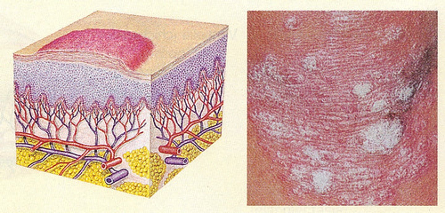 <p>Hiernaast zien we een bepaald type squameus letsel (psoriasis annulare), welk type schilfering komt hiermee overeen?</p>