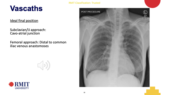 <p>Subclavian/IJ approach:</p><p class="p1">Cavo-atrial junction</p><p class="p1">Femoral approach: Distal to common</p><p class="p1">iliac venous anastomoses</p>
