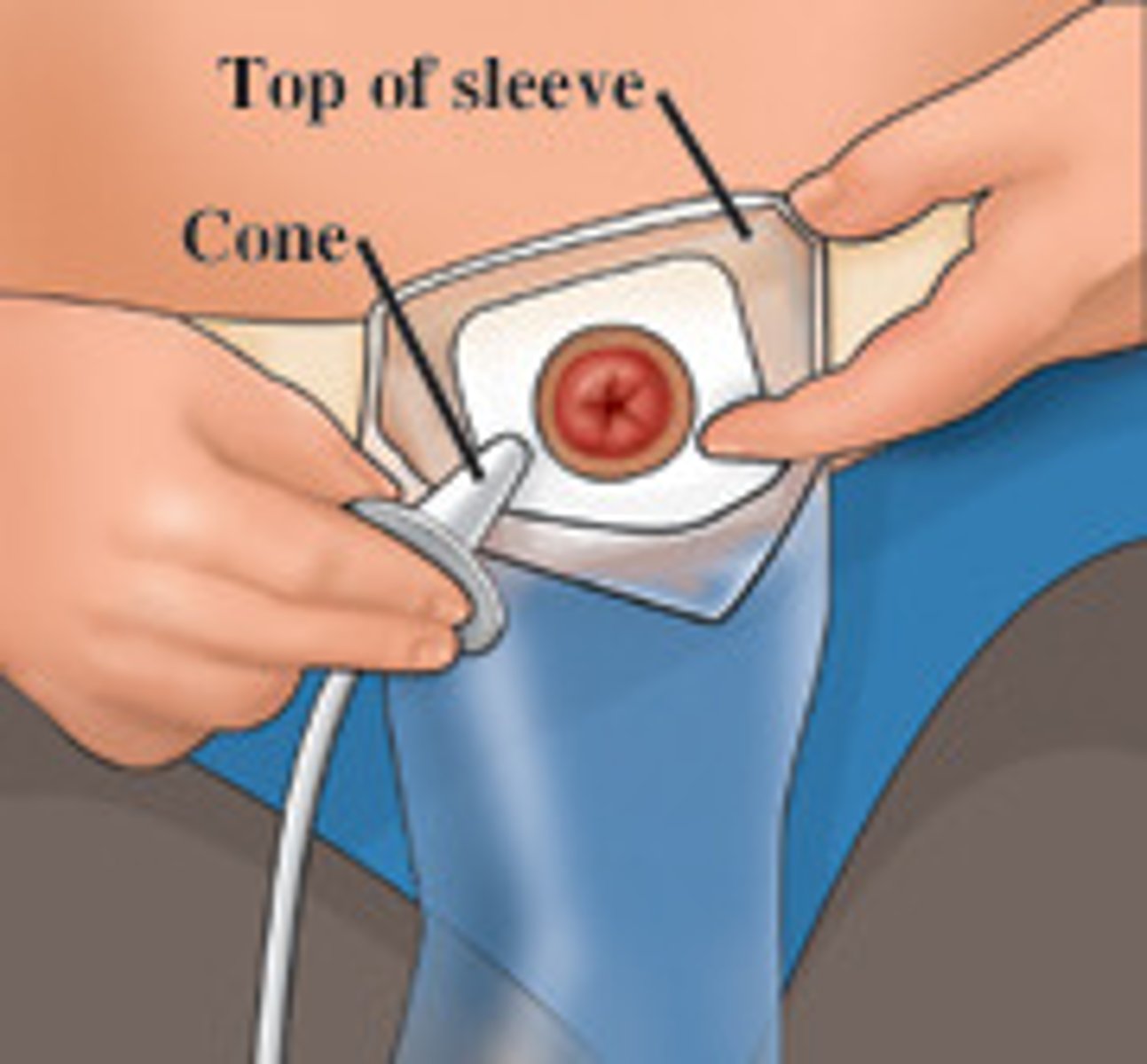 <p>an opening of the intestine on the skin</p>