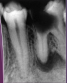 <p>What would you see microscopically in a periapical cyst?</p>