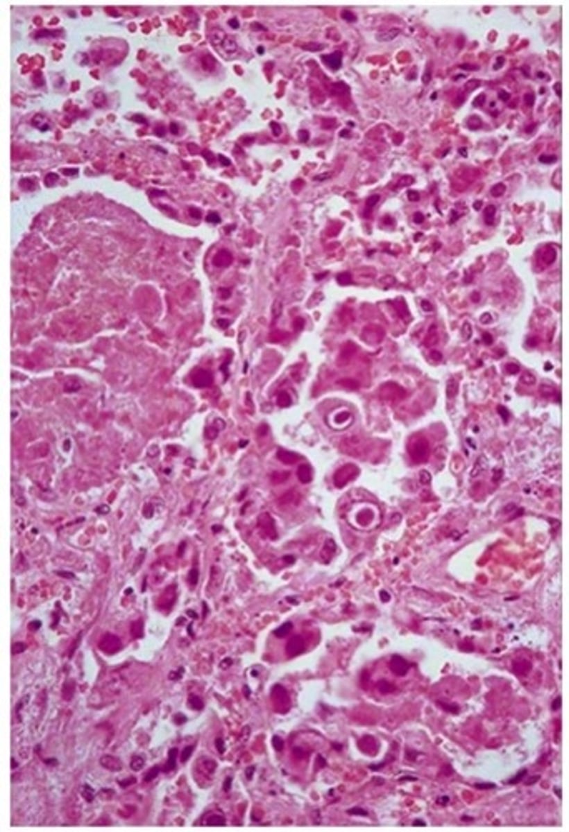 <p>Risk Factors</p><p>-Immunosupressive Durgs following Organ Transplant</p><p>Histo</p><p>-Infected cells w/ prominent Basophilic nuclear inclusions</p>
