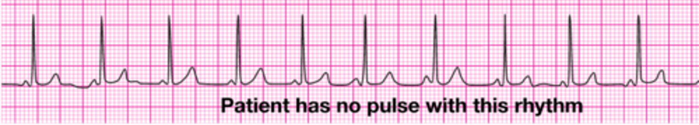 <p>- any organized rhythm on EKG WITHOUT a palpable pulse</p><p>- treatment: focus on high-quality CPR, identifying reversible causes, give epinephrine</p>