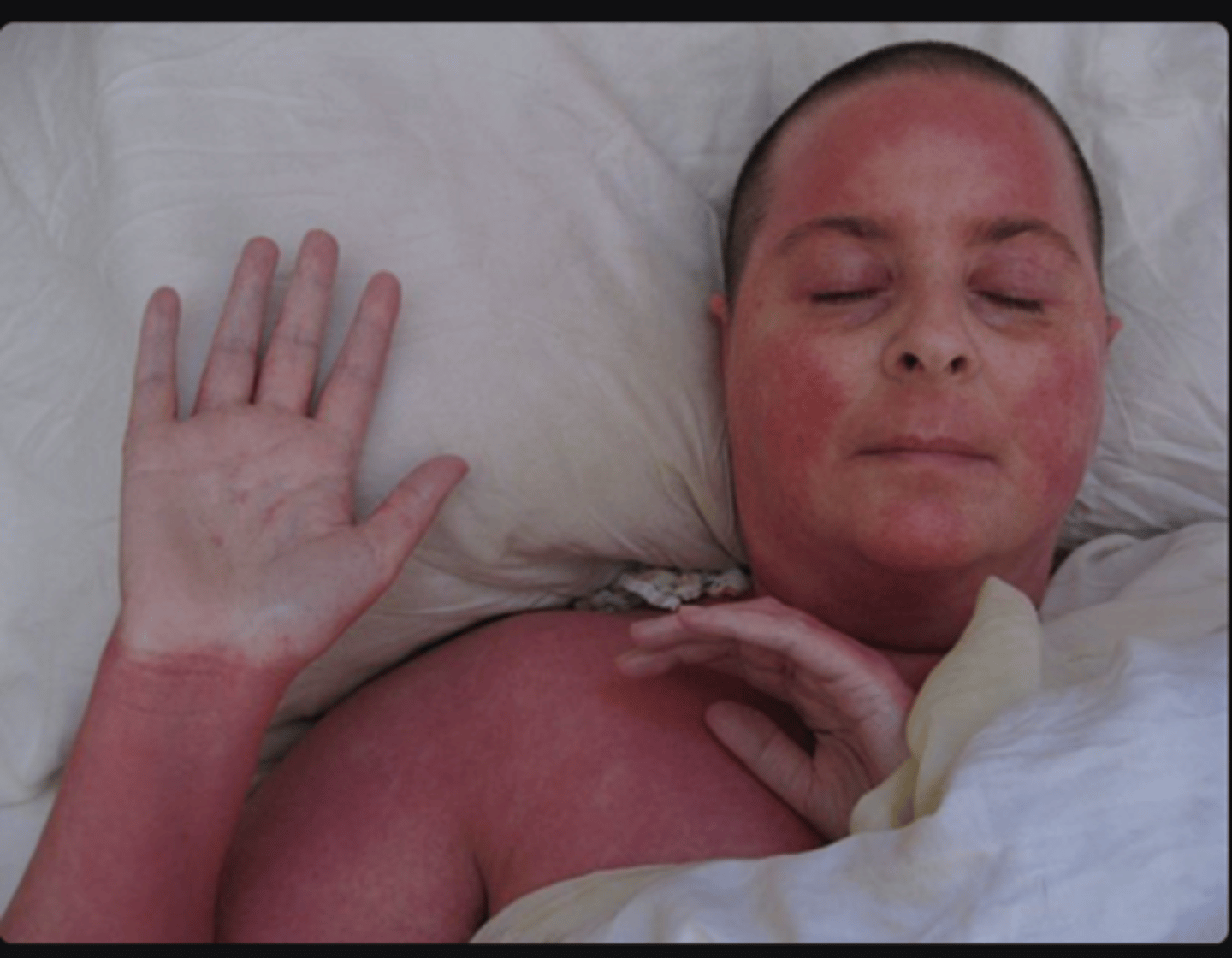 <p>life-threatening dermatological condition where there is widespread erythema covering more than 90% of the body's skin surface.</p>