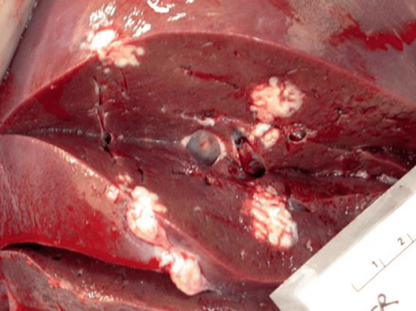 <p>what type of exudate is being depicted in the image?</p>