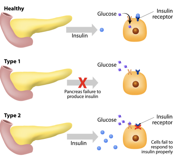 <ul><li><p>Can’t regulate blood sugar</p></li><li><p>Blood sugar can go to dangerously high levels</p></li><li><p>Type I: Pancreas doesn’t make enough insulin</p></li><li><p>Type II: Cells are insensitive to insulin</p></li></ul>