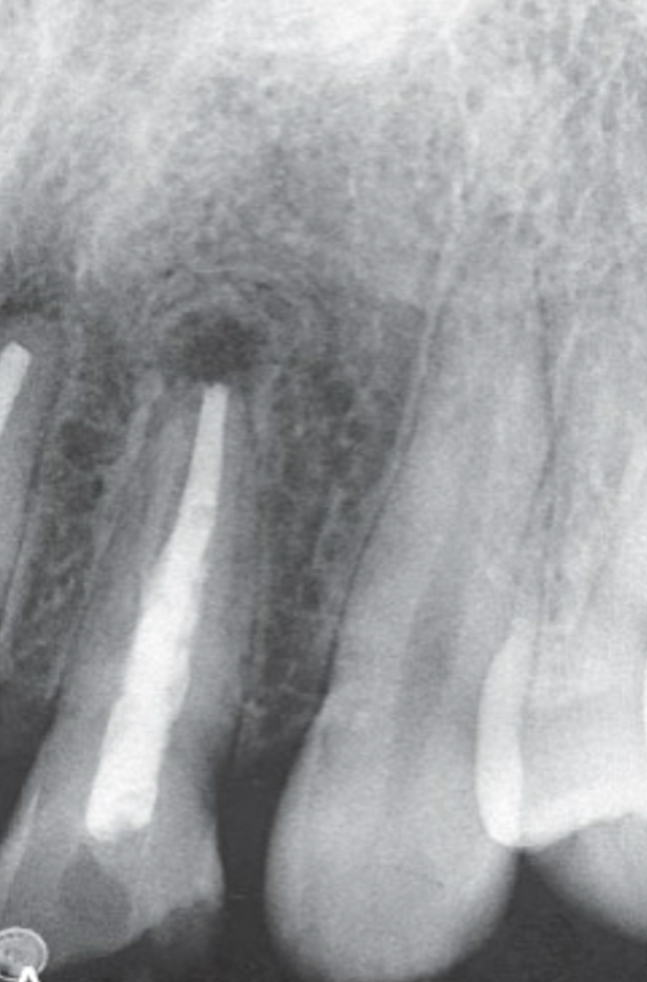<p>previous periapical cyst can heal with bone</p><ul><li><p>occasionally heals with fibrous tissue instead</p><ul><li><p>fibrous tissue is radiolucent</p></li></ul></li><li><p>always asymptomatic</p></li><li><p>can be difficult to differentiate between periapical scar and periapical cyst radiographically</p></li></ul><p></p>