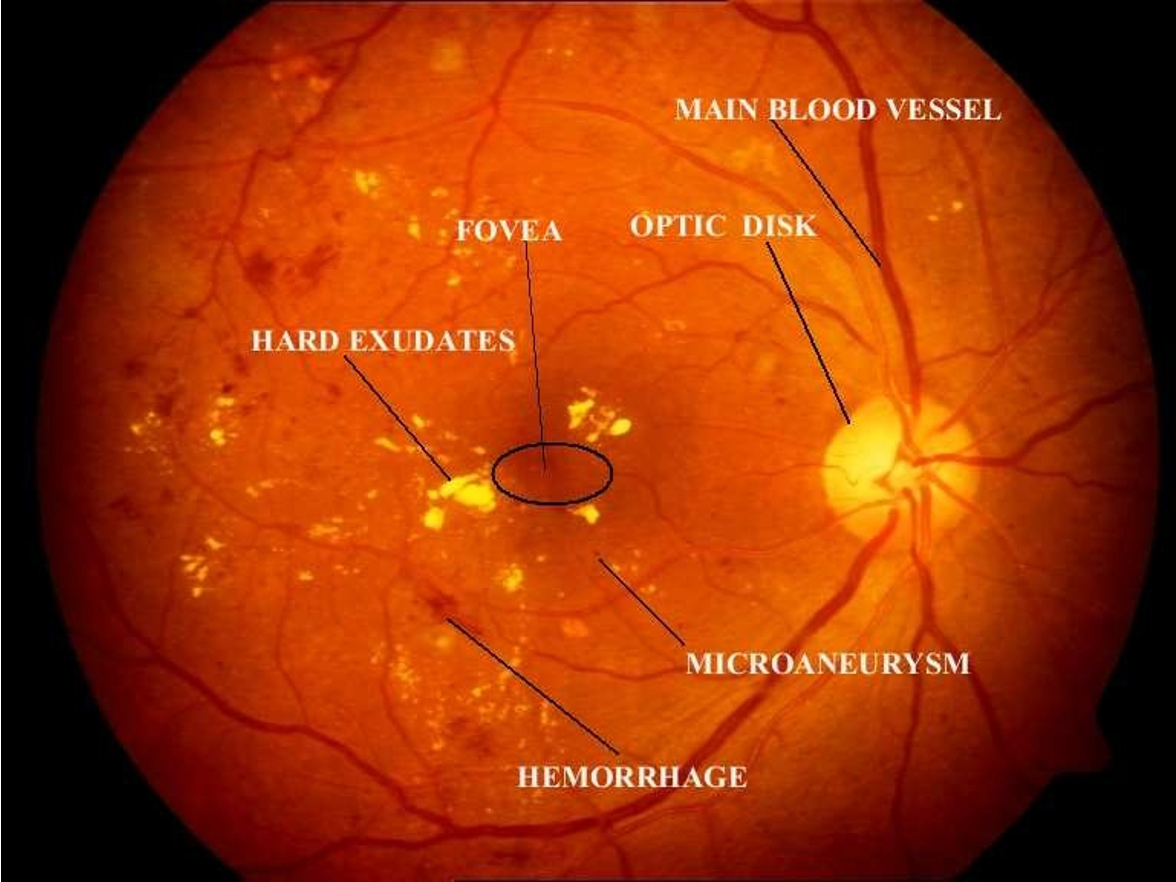 <p>leading cause of blindness; proliferative + non proliferative</p>