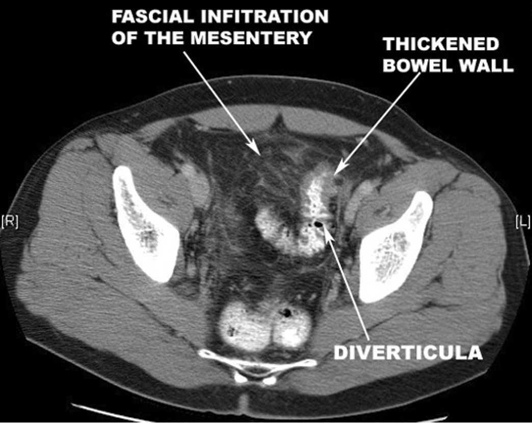 <p>stranding, fatty infiltration, streaking, “dirty fat”, phlegmon, “mural thickening of the colon w/ pericolic fat stranding”</p>