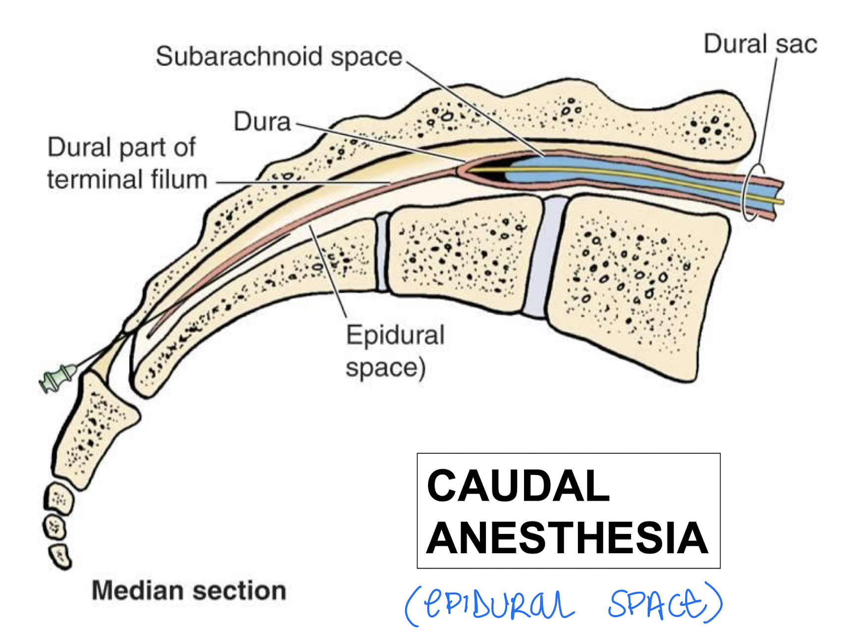 <p>Needle enters through the sacral foramina (sacral hiatus) and into the vertebral canal</p>