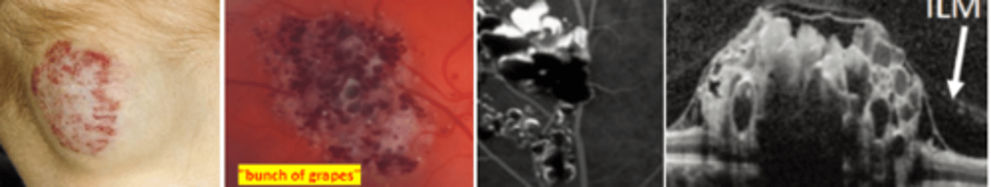 <p>rare benign tumors of the inner retina or surface of the ONH which are congenital (autosomal dominant) and unilateral. Is associated with systemic/CNS disorders such as cranial nerve palsies and epilepsy. Breaks in the ILM can result in epiretinal membrane formation. Hemorrhage may rarely occur.</p>