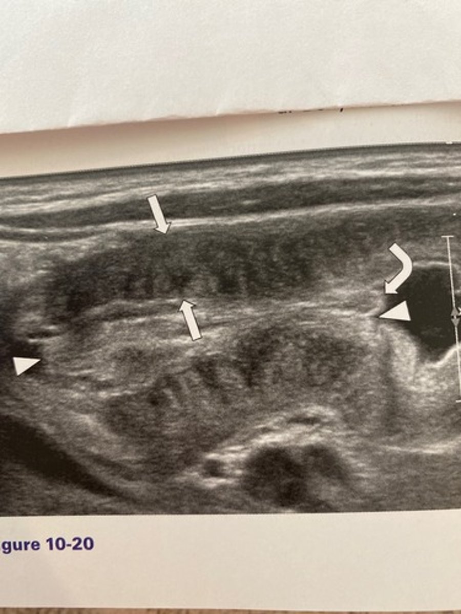 <p>The measurement identified by the arrows in</p><p>Figure 10-20 should not exceed:</p><p>a. 2 mm.</p><p>b. 3 mm.</p><p>c. 3.5 mm.</p><p>d. 6 mm.</p>