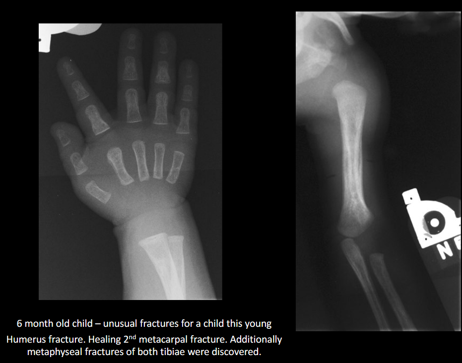 <p>Corner/bucket-handle fracture.</p>