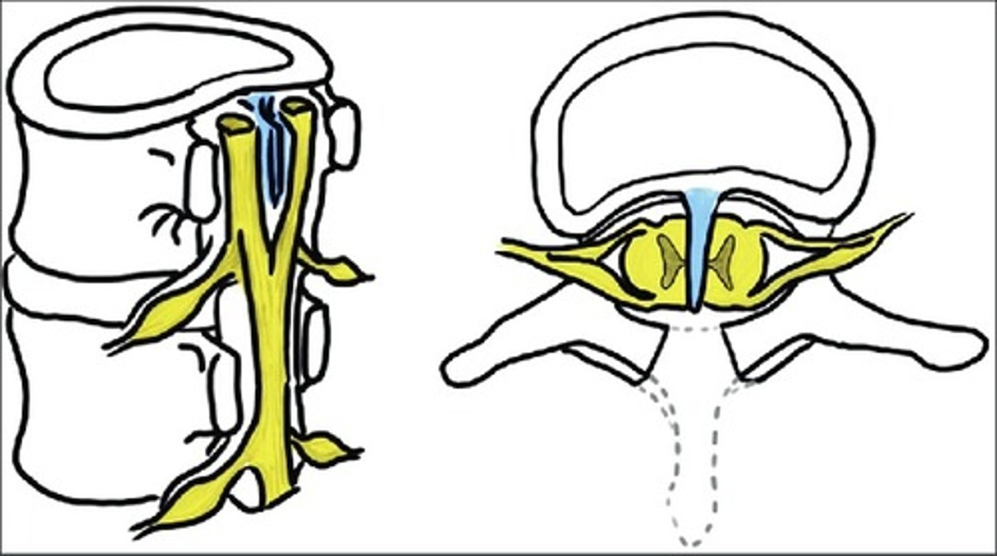 <p>- zeldzame ontwikkelingsstoornis</p><p>- splijting RM door beenderige wig</p>