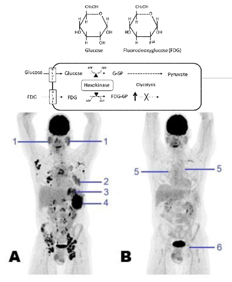 <p>18F Fluorodeoxyglucose is an analogue taken up by cells and can be detected by positron emission tomography</p>