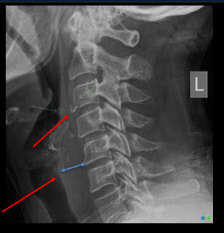 <p>describe this radiograph</p>